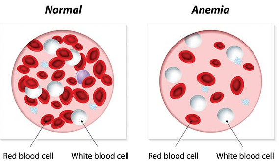аутоиммунная гемолитическая анемия картина крови