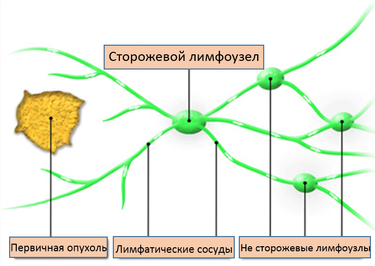 Биопсия сторожевых лимфоузлов в Израиле